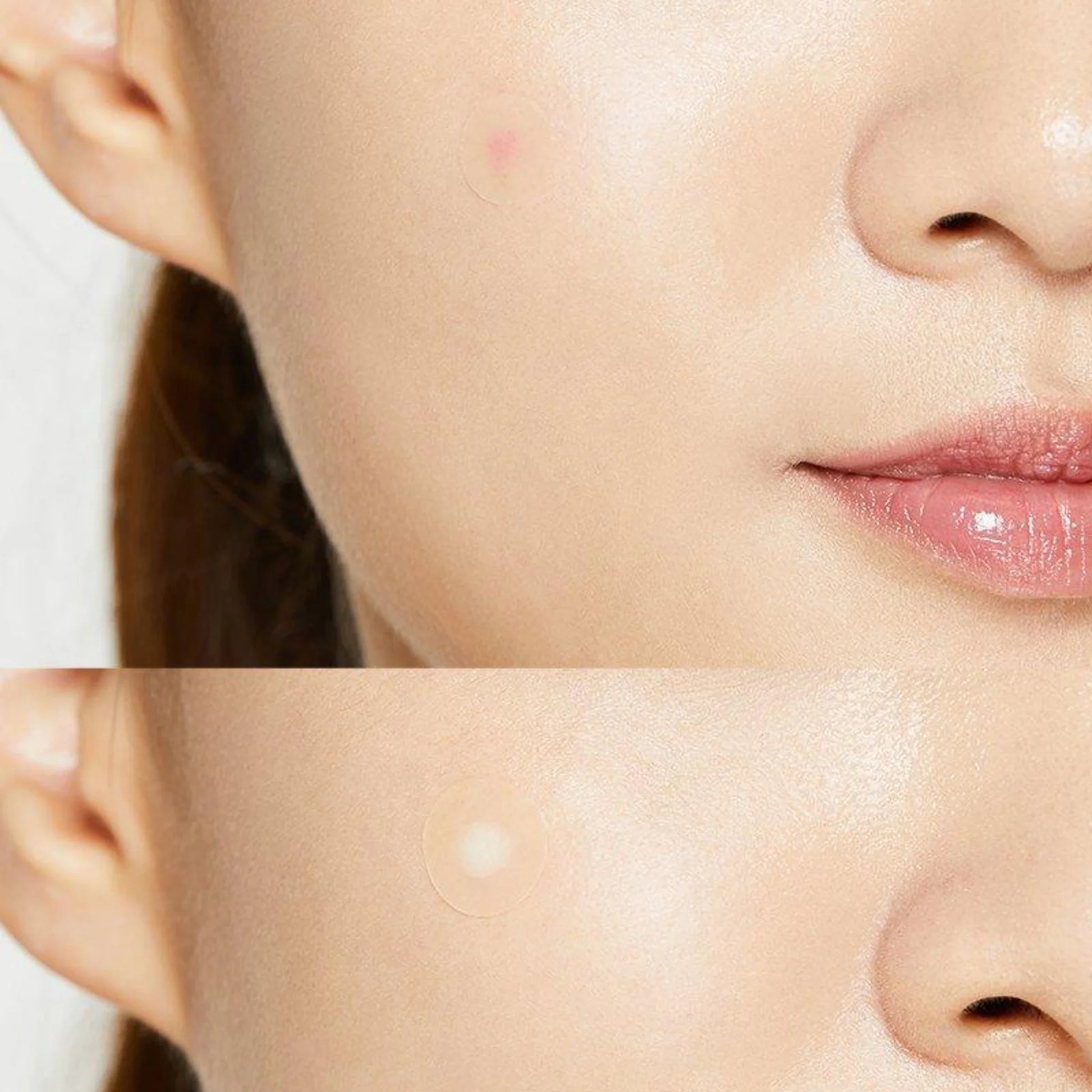 COSRX Acne Pimple Master patch showcase